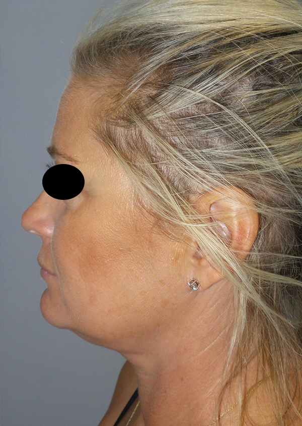 Submental Liposuction Before and After 01 | Grover Aesthetics