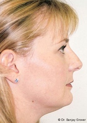 Submental Liposuction Before and After | Grover Aesthetics