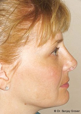 Submental Liposuction Before and After | Grover Aesthetics