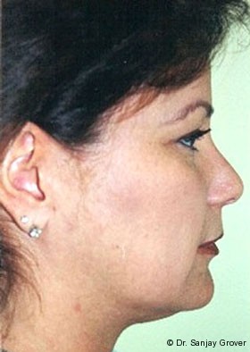 Submental Liposuction Before and After | Grover Aesthetics