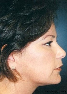 Submental Liposuction Before and After | Grover Aesthetics