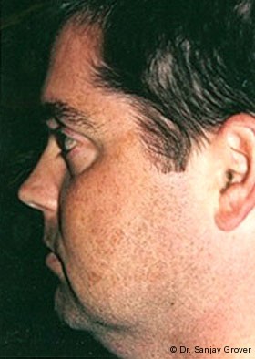 Submental Liposuction Before and After | Grover Aesthetics
