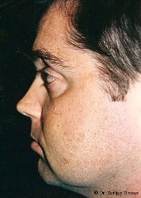 Submental Liposuction Before and After | Grover Aesthetics