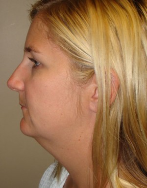 Submental Liposuction Before and After | Grover Aesthetics
