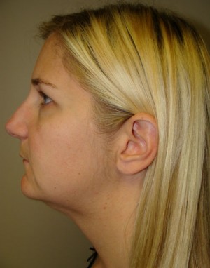 Submental Liposuction Before and After | Grover Aesthetics