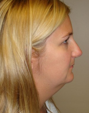 Submental Liposuction Before and After 05 | Grover Aesthetics