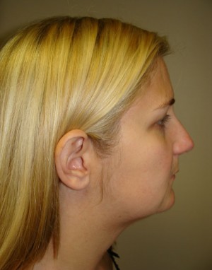 Submental Liposuction Before and After 05 | Grover Aesthetics