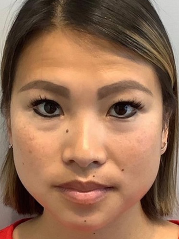 Botox Before and After | Grover Aesthetics