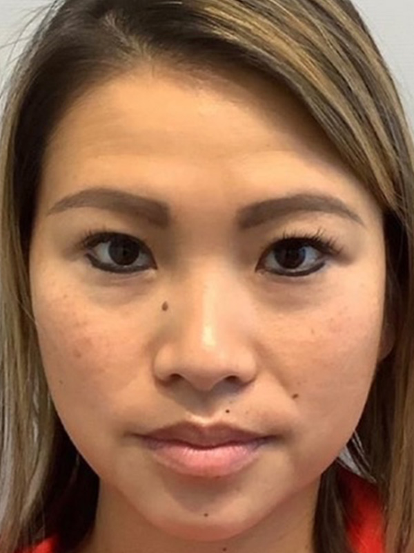 Botox Before and After | Grover Aesthetics