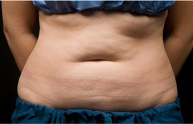 Coolsculpting Before and After 23 | Sanjay Grover MD FACS