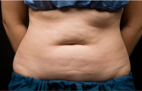 Coolsculpting Before and After 13 | Sanjay Grover MD FACS