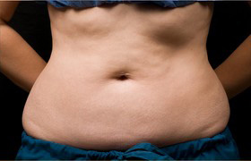 Coolsculpting Before and After | Grover Aesthetics