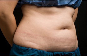 Coolsculpting Before and After 01 | Sanjay Grover MD FACS