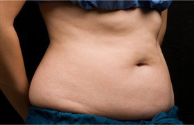 Coolsculpting Before and After 01 | Grover Aesthetics
