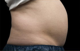 Coolsculpting Before and After | Grover Aesthetics