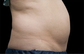 Coolsculpting Before and After | Grover Aesthetics