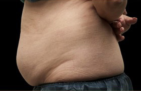 Coolsculpting Before and After | Grover Aesthetics