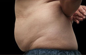 Coolsculpting Before and After | Grover Aesthetics