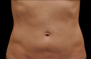 Coolsculpting Before and After | Grover Aesthetics
