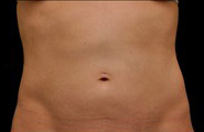 Coolsculpting Before and After 04 | Grover Aesthetics