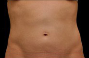 Coolsculpting Before and After 04 | Sanjay Grover MD FACS