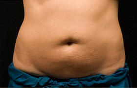 Coolsculpting Before and After 07 | Sanjay Grover MD FACS