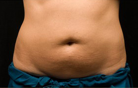 Coolsculpting Before and After 20 | Sanjay Grover MD FACS