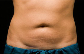 Coolsculpting Before and After | Grover Aesthetics