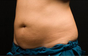 Coolsculpting Before and After 05 | Sanjay Grover MD FACS