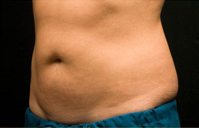 Coolsculpting Before and After 05 | Grover Aesthetics