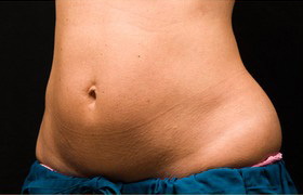 Coolsculpting Before and After 20 | Sanjay Grover MD FACS