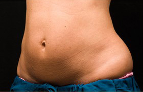 Coolsculpting Before and After | Grover Aesthetics