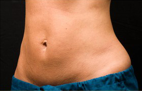 Coolsculpting Before and After 06 | Sanjay Grover MD FACS