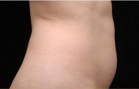 Coolsculpting Before and After 07 | Sanjay Grover MD FACS