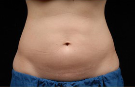 Coolsculpting Before and After 20 | Sanjay Grover MD FACS