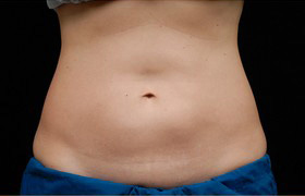 Coolsculpting Before and After | Sanjay Grover MD FACS