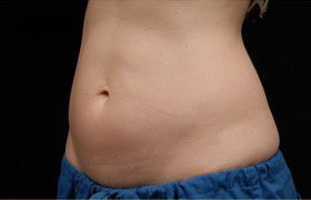 Coolsculpting Before and After 08 | Sanjay Grover MD FACS