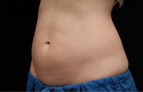 Coolsculpting Before and After 08 | Grover Aesthetics