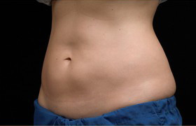 Coolsculpting Before and After 08 | Grover Aesthetics