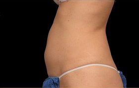 Coolsculpting Before and After 09 | Sanjay Grover MD FACS