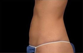 Coolsculpting Before and After 09 | Sanjay Grover MD FACS