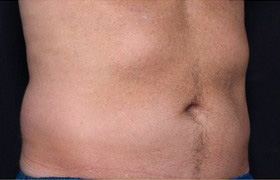 Coolsculpting Before and After 11 | Sanjay Grover MD FACS