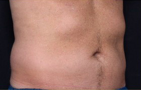 Coolsculpting Before and After 13 | Sanjay Grover MD FACS