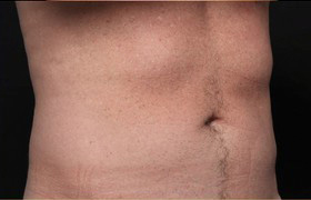 Coolsculpting Before and After 10 | Sanjay Grover MD FACS