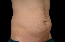 Coolsculpting Before and After | Grover Aesthetics