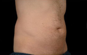 Coolsculpting Before and After 11 | Sanjay Grover MD FACS