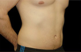 Coolsculpting Before and After 08 | Sanjay Grover MD FACS