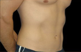 Coolsculpting Before and After | Sanjay Grover MD FACS