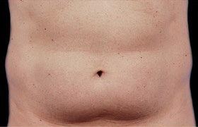 Coolsculpting Before and After 06 | Sanjay Grover MD FACS