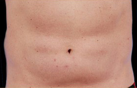 Coolsculpting Before and After | Grover Aesthetics